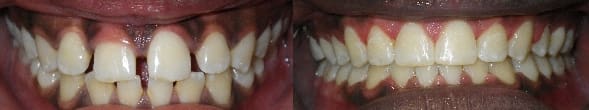 Details: Correction of spacing & overjet with traditional braces