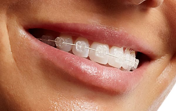 Ceramic Braces in Atlanta & Marietta, GA