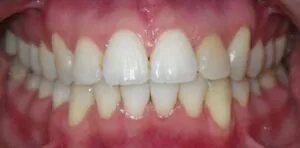 Braces Before and After Pictures Atlanta, GA