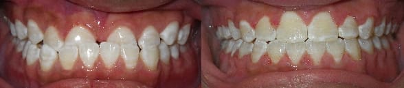 Traditional braces to treat Class III malocclusion with spacing and underbite.
