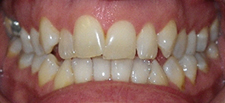 SureSmile Before and After Pictures Atlanta, GA