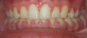 Braces Before and After Pictures Atlanta, GA
