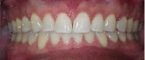 Zoom!® Teeth Whitening Before and After Pictures Atlanta, GA