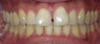 Invisalign® Before and After Pictures Atlanta, GA