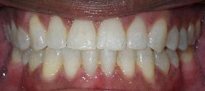 Braces Before and After Pictures Atlanta, GA
