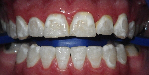 Zoom!® Teeth Whitening Before and After Pictures Atlanta, GA