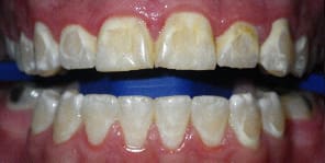 Zoom!® Teeth Whitening Before and After Pictures Atlanta, GA