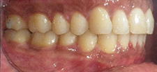 SureSmile Before and After Pictures Atlanta, GA