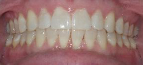 Invisalign® Before and After Pictures Atlanta, GA