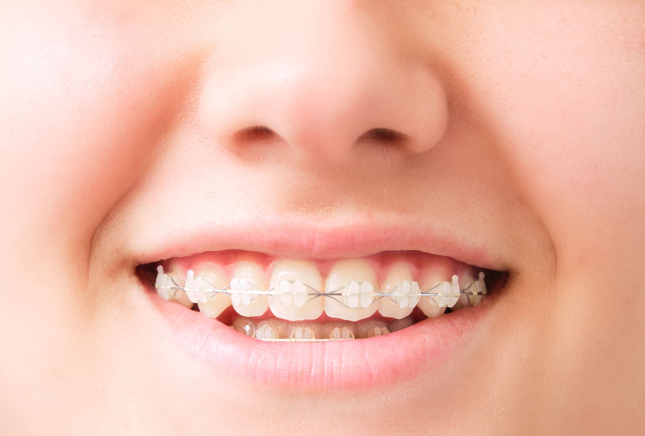 Ceramic Braces in Atlanta and Marietta, GA